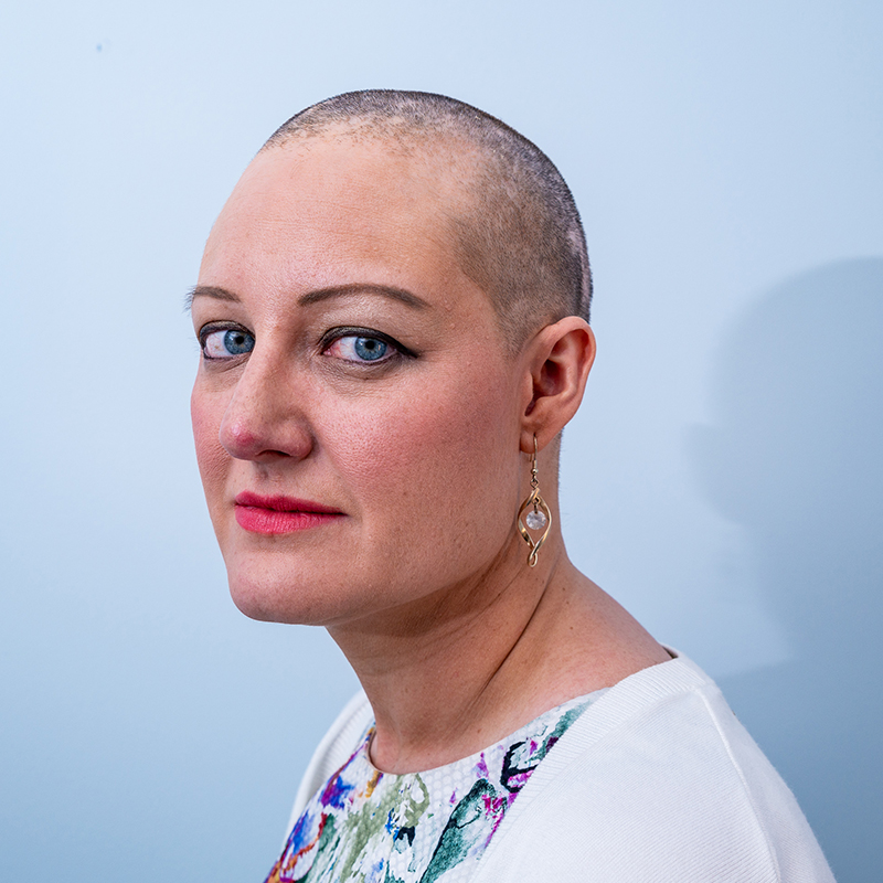 A woman with alopecia wearing a white top looks to the camera, against a blue background.