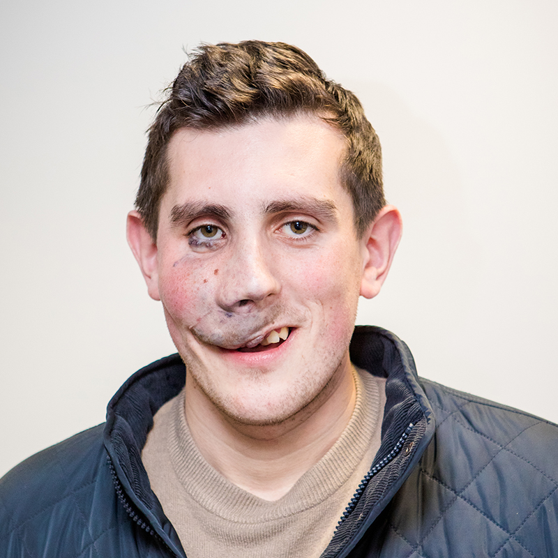 A young man with a facial birthmark smiles at the camera. He is wearing a blue jacket.