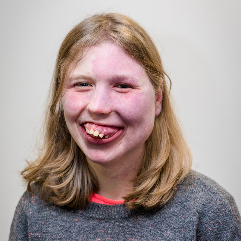 A teenage girl, who has Sturge-Weber syndrome and a birthmark on her face, smiles at the camera. She has short blonde hair and is wearing a grey jumper.