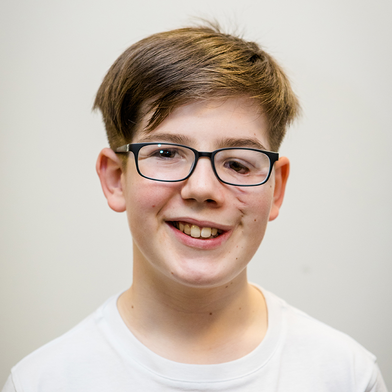 A young boy who has a facial cleft is wearing glasses and a white top. He smiles directly at the camera.