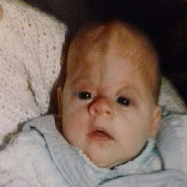 A baby with complex craniosynostosis wears a blue baby grow and is being held in someone's arms.