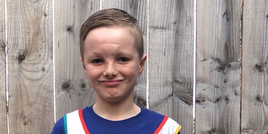 A young boy with facial scars stands in front of a wooden fence, smiling. He wears a blue top.