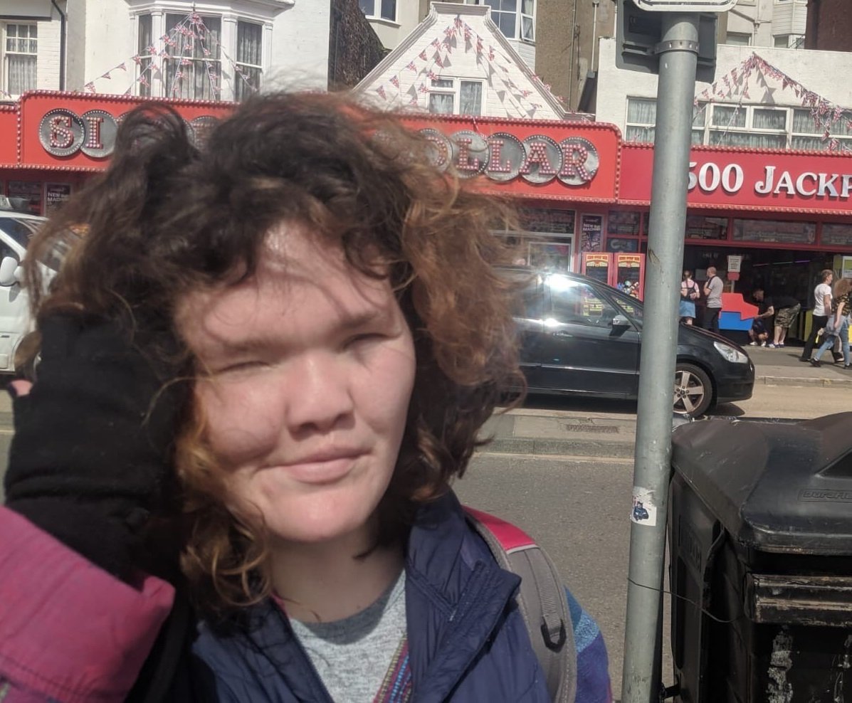 A woman with a visible difference outdoors with street in the background