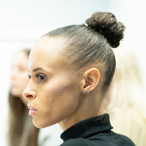 Natalie who has vitiligo wears a black polo neck jumper and stands in profile