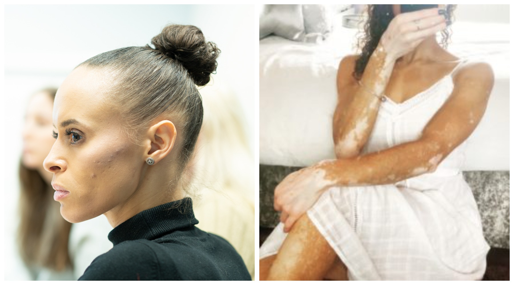 On left, a woman in profile wears a black polo neck; on the right she takes a selfie of her arms and torso, showing her vitiligo.