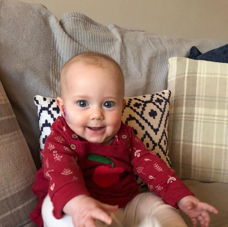 A baby girl with a birthmark on her right cheek sits propped up on a cushion, and is wearing a red top.