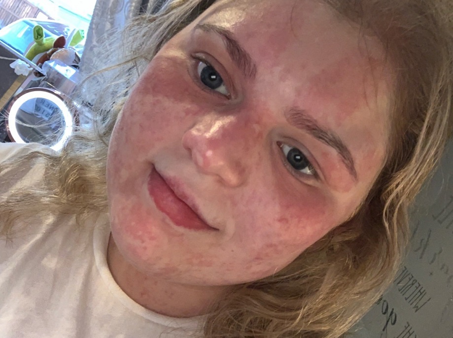 A teenage girl with a birthmark covering her face takes a selfie without makeup.