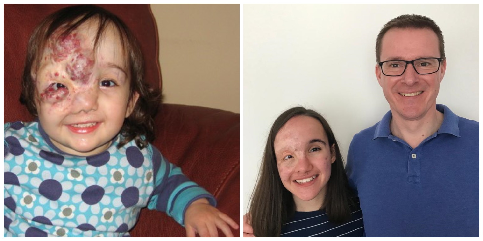 Two photos: on the left is a baby girl with a birthmark; on the right the girl is a smiling teenager, standing next to her dad, dressed in blue.