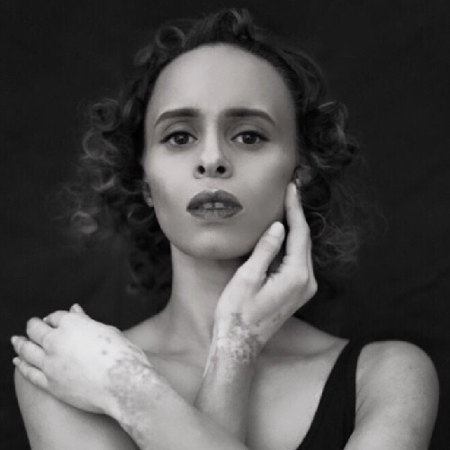 A black and white photo of Natalie who has vitiligo - Natalie poses with her hands to her face