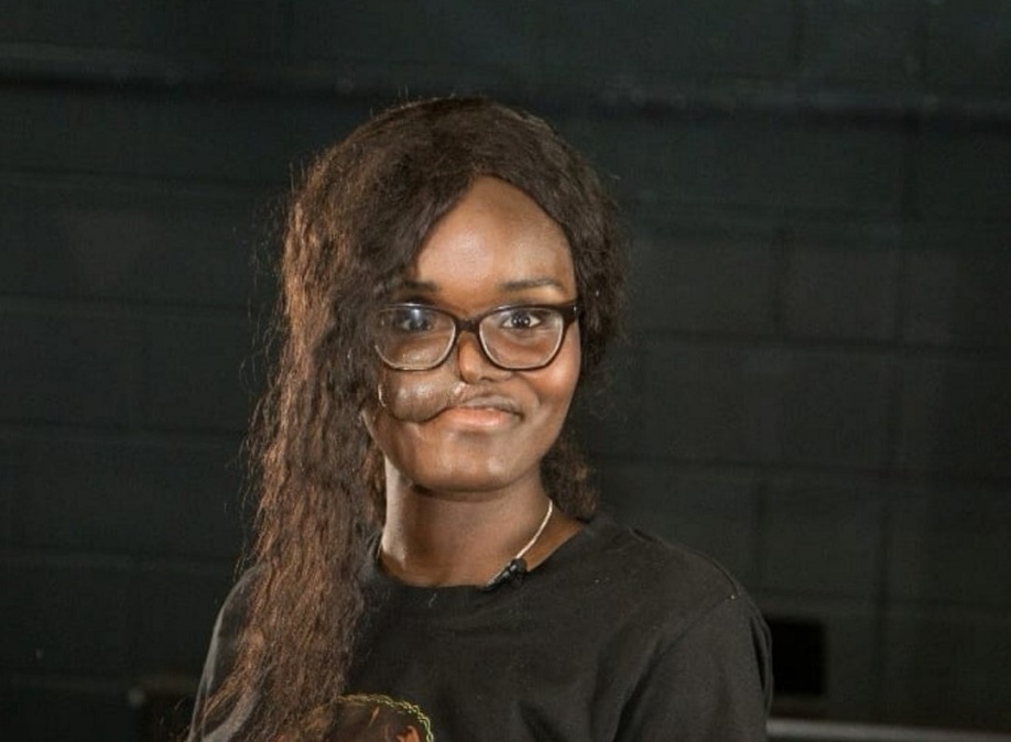 A young woman, who has a skin flap on her right cheek caused by removing a tumour, smiles at the camera. She is wearing glasses and a black t-shirt.