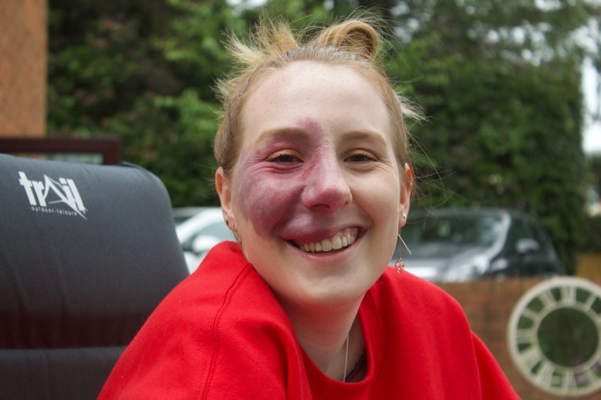 A young woman who has a port wine birthmark on her face smiles at the camera. She is wearing a red top.