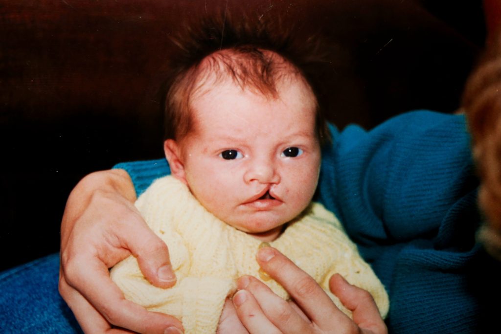 A baby with a cleft lip and palate wears a yellow cardigan and is being held in a person's arms.