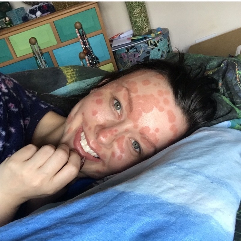 A young woman with psoriasis lies on a blue pillow, smiling at the camera.