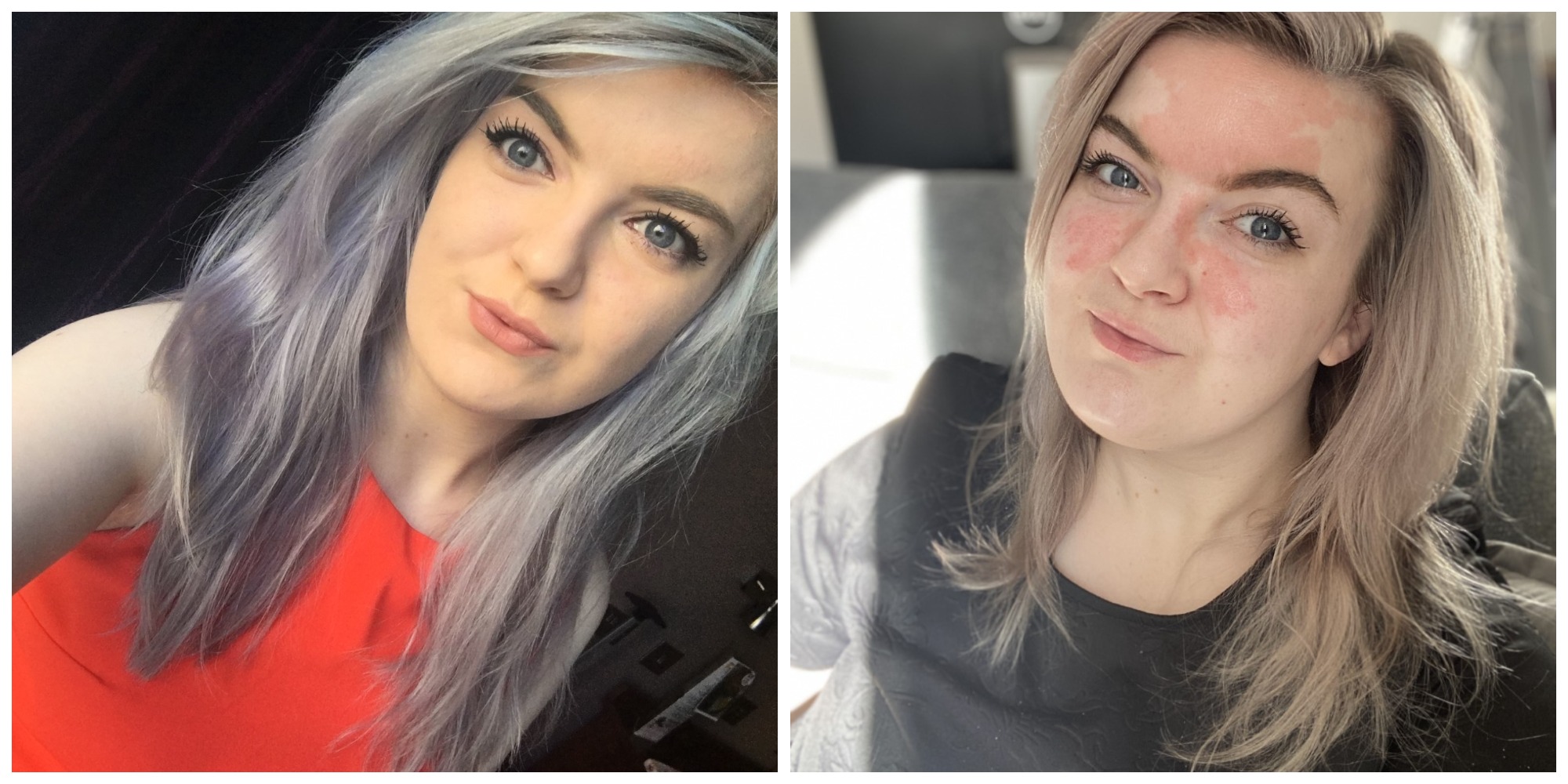 Two photos show a young woman who has psoriasis on her face, wearing a red top in one photo, black in the other.