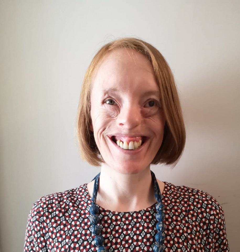 A woman with amniotic band syndrome wearing a patterned dress smiles at the camera.