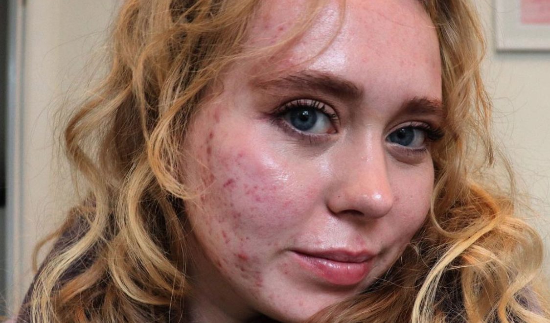 Headshot of Isabella with facial acne, looking towards the camera with a closed smile