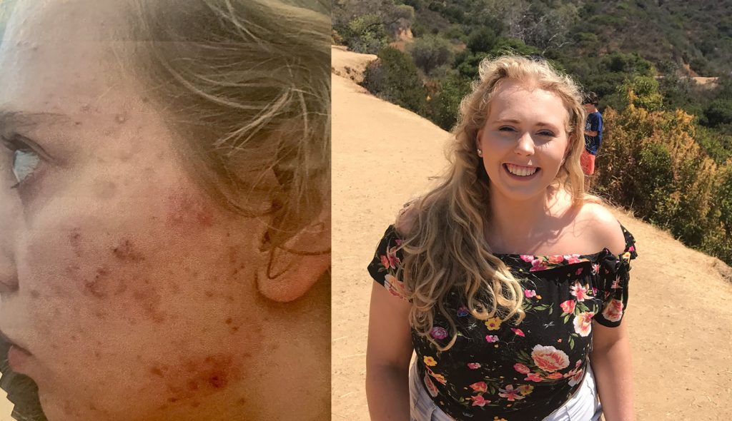 Left: a close-up side view of a woman's face with acne. Right: a woman with long blonde hair smiling and looking at the camera, with a path and trees in the background