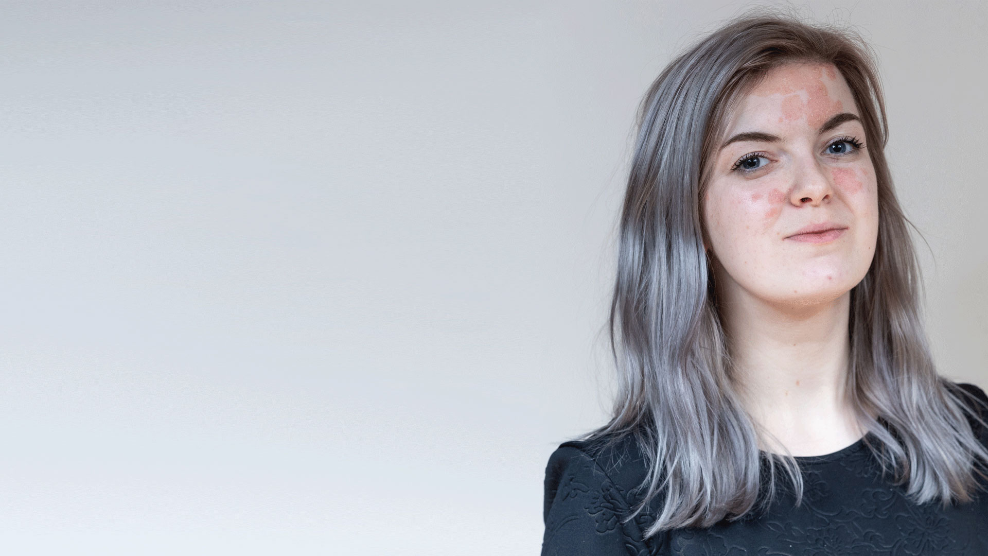 A young woman with a visible difference looking towards the camera