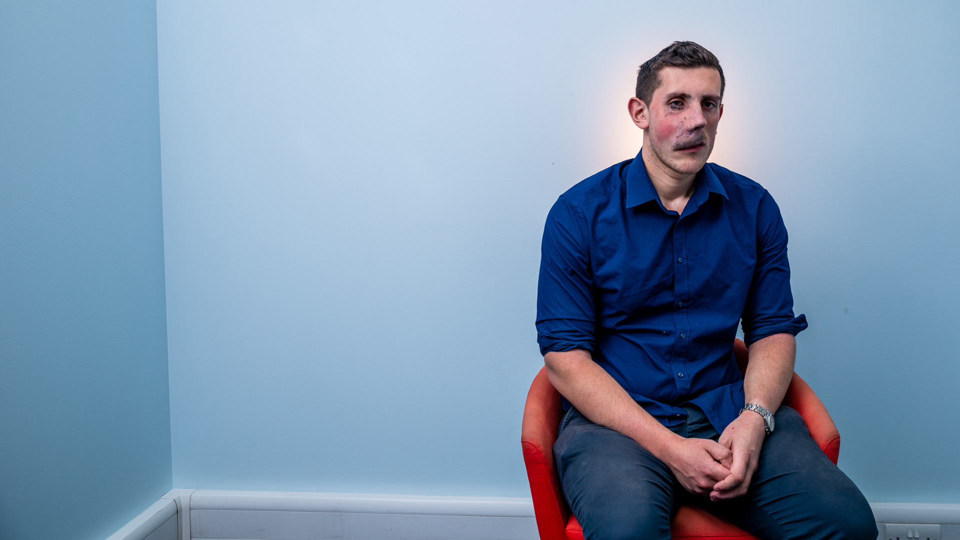 A man with a visible difference sits alone in a chair, looking off camera