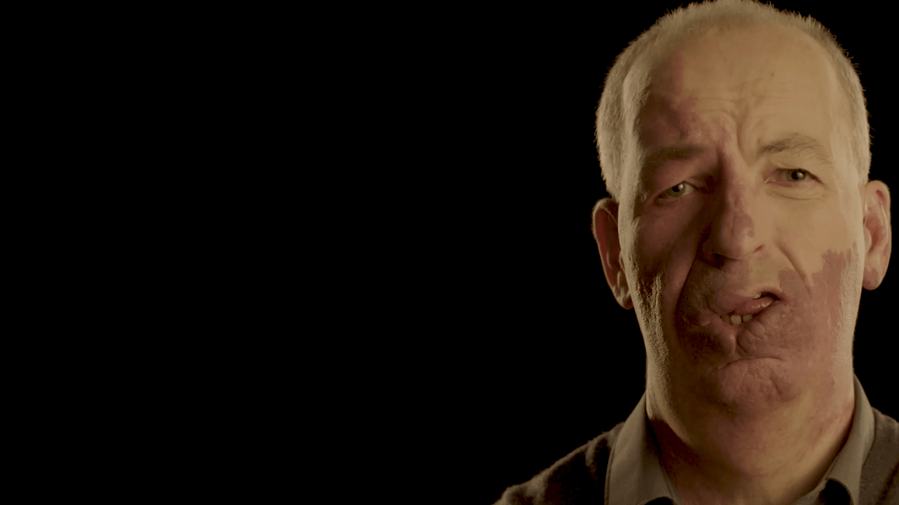 A man with a facial birthmark against a black background