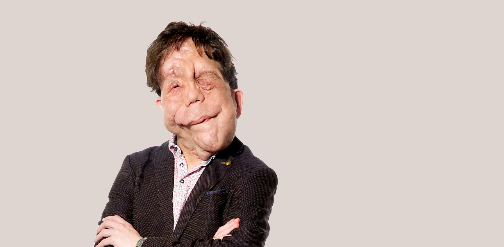 A man with a visible difference in a suit with his arms folded