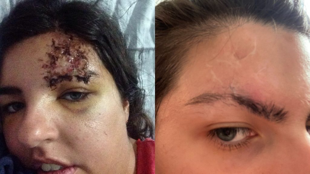 Left: a close-up of Sophie's forehead after the accident. An open wound is visible. Right: Sophie's forehead a few weeks later. It has healed and there are scars on her forehead and through her right eyebrow.