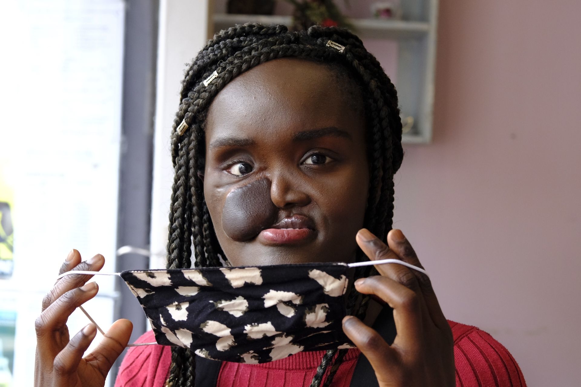 Crystal, a young woman in her early 20s. She has a skin flap on her cheek and braided hair. She's wearing a pink/red jumper and is holding up a face covering in front of her. 