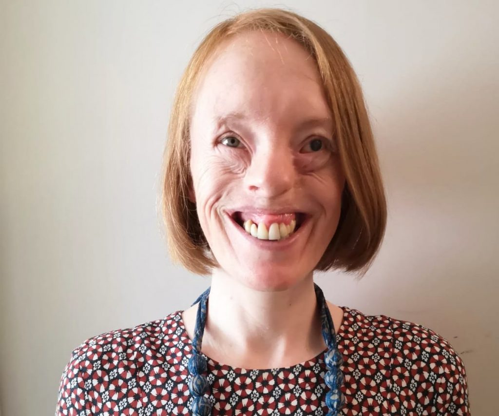 A woman with amniotic band syndrome wearing a chunky blue necklace and a patterned dress smiles at the camera.