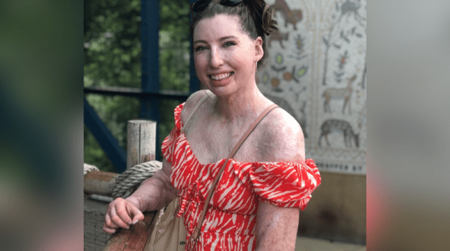 Ambassador Catrin Pugh who has a visible difference, wearing her brown hair up, with an orange sun dress