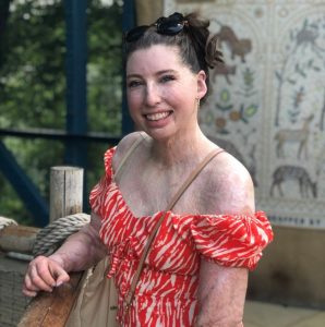 Ambassador Catrin who has a visible difference wearing an orange and white summer dress