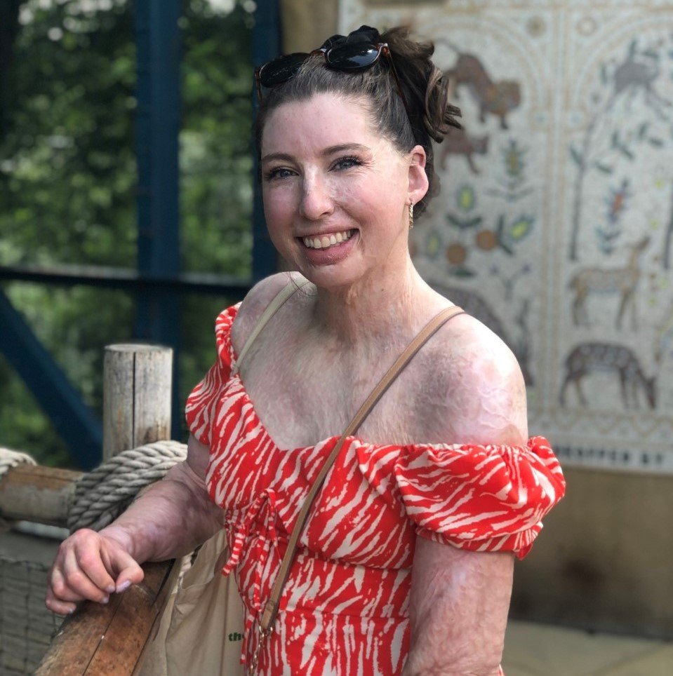 Ambassador Catrin who has a visible difference wearing an orange and white summer dress