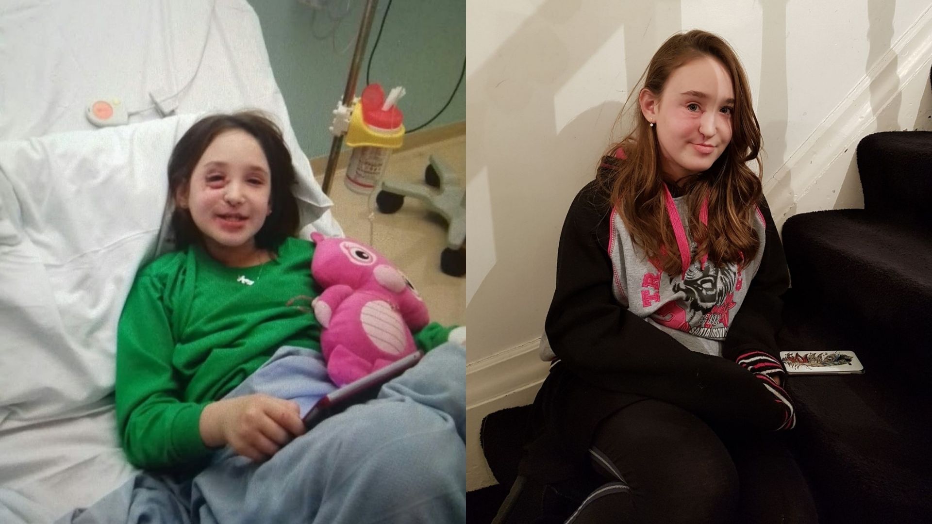 Left: Abigail, pictured at age 7-8. She has medium length dark brown hair and her eye is swollen. She's wearing a green jumper and is sitting in a hospital bed with a pink toy. Right: Abigail, at age 16. She has long light brown hair and facial scarring. She's wearing a grey and black hoodie with pink attachments. She's sitting on the stairs and looking at the camera.