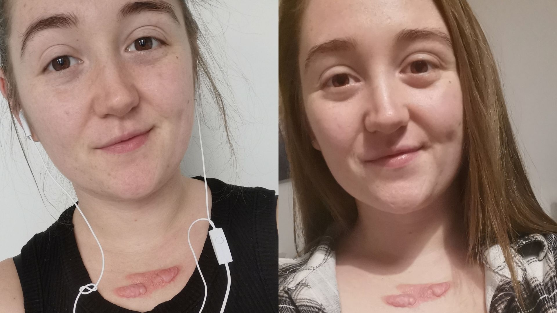 Left: Chloe, a white woman in her early 20s who's wearing a black tank top and air pods. She has keloid scars. Right: Chloe, wearing a check shirt.