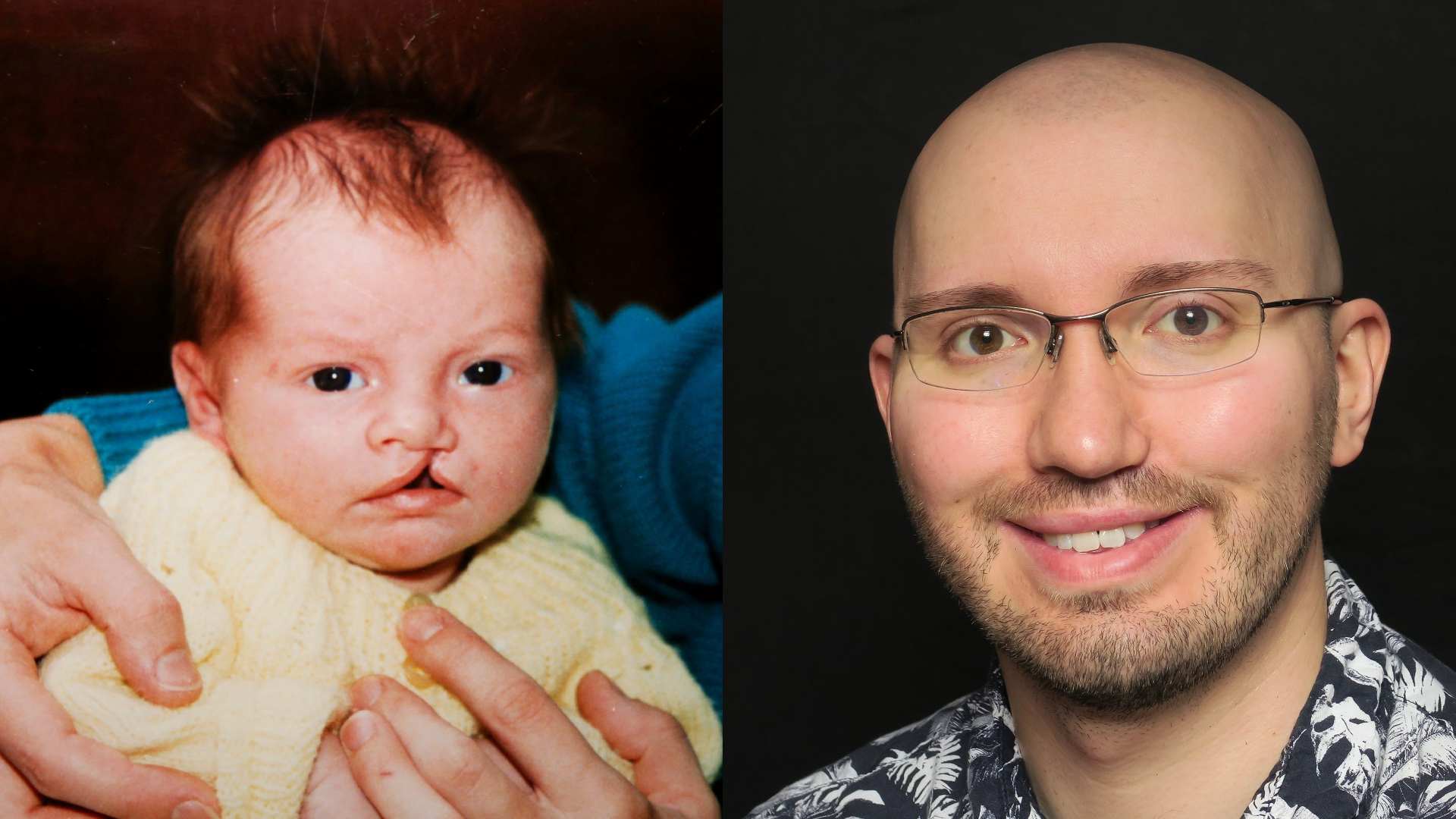 Left: a baby with a cleft lip being held in someone's arms. Right: a man with glasses, wearing a black and white shirt smiling towards the camera