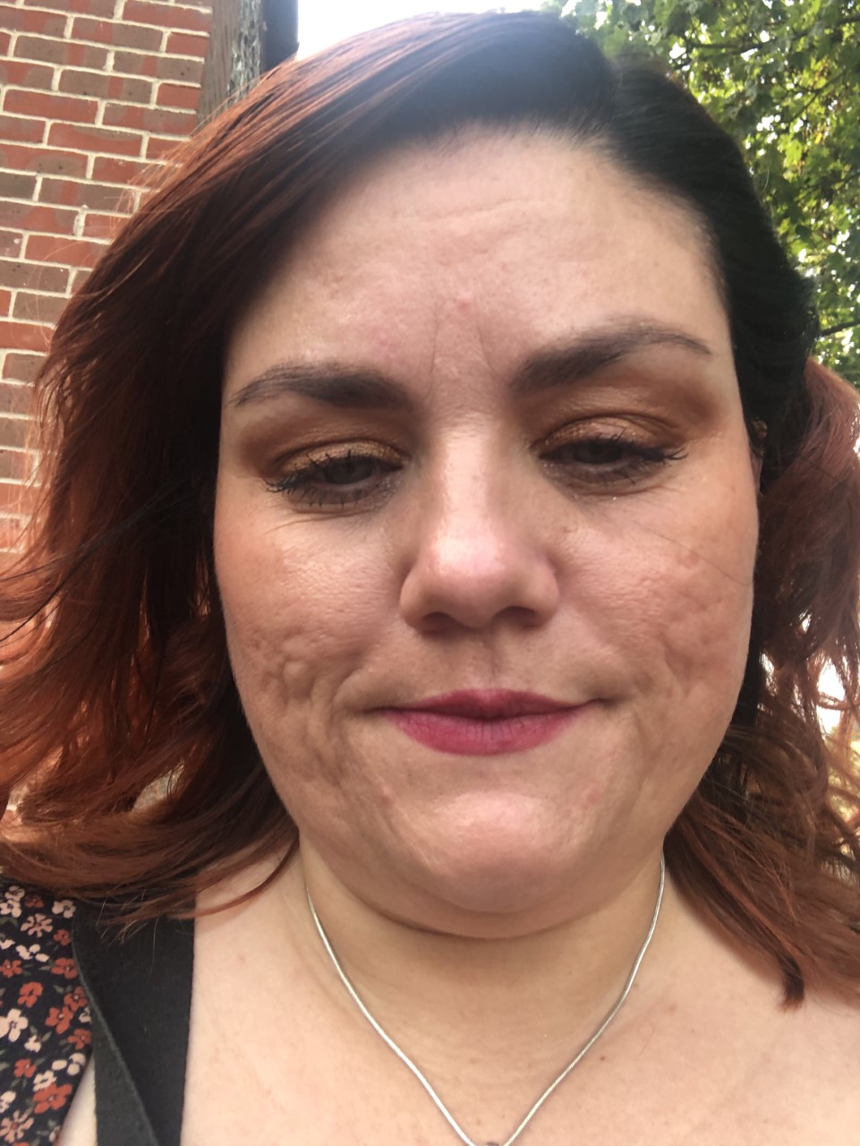 A close up image of a white woman with dark red hair who has marks on her skin from acne