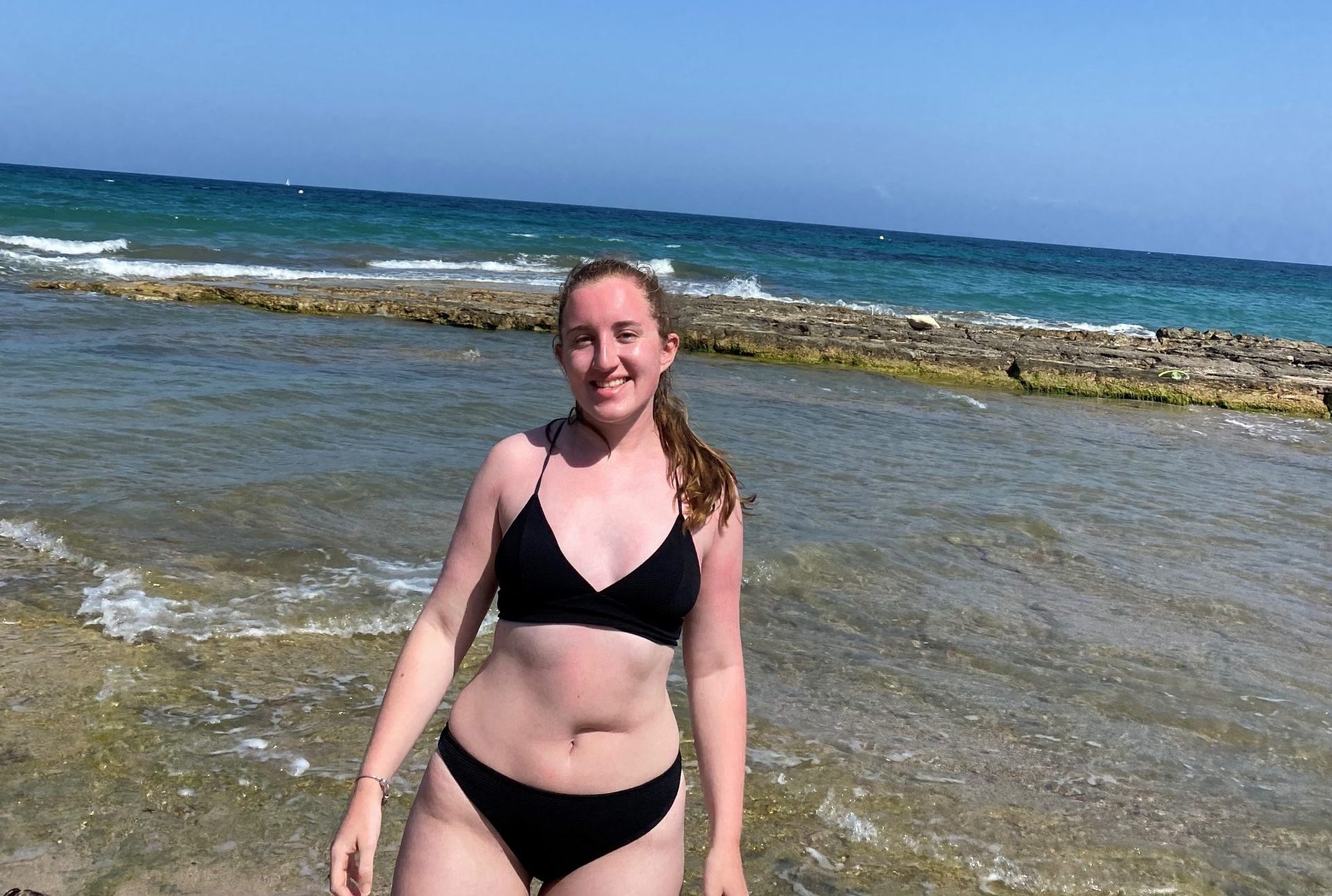 Allie in her black bikini, smiling in front of a beautiful beach. Her abdominal scar is visible