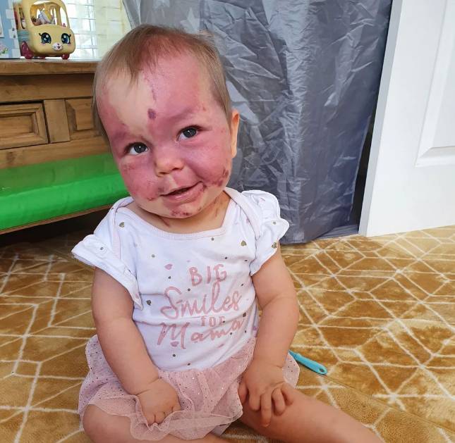 Baby Lily sat on the kitchen floor, smiling cheekily towards the top right corner of the picture. She has a port wine stain that covers most of her face. She's wearing a baby grow that reads: "big smiles for mama"