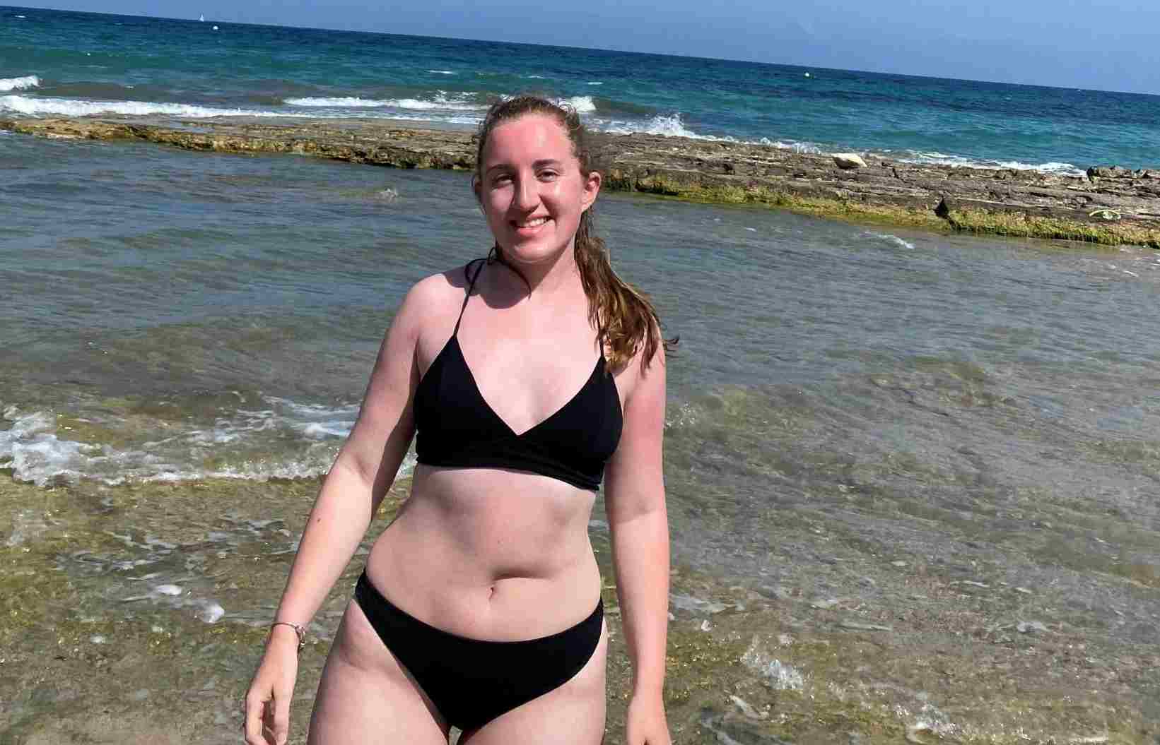 A young woman in a black bikini with a scar near her belly button