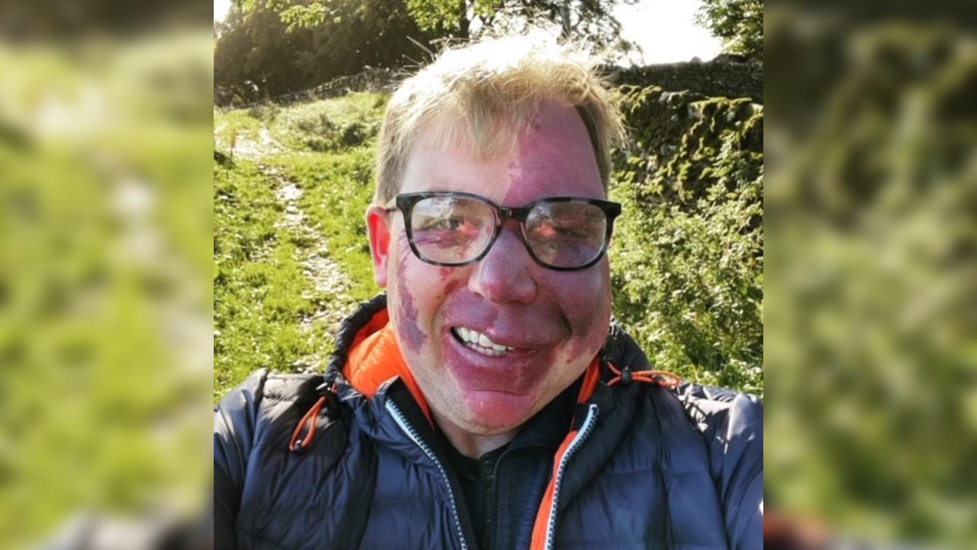 Man with glasses and port wine stain birthmark on face takes selfie in the countryside