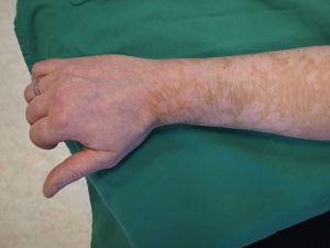 An white-skinned arm against a green background showing cafe-au-lait spots