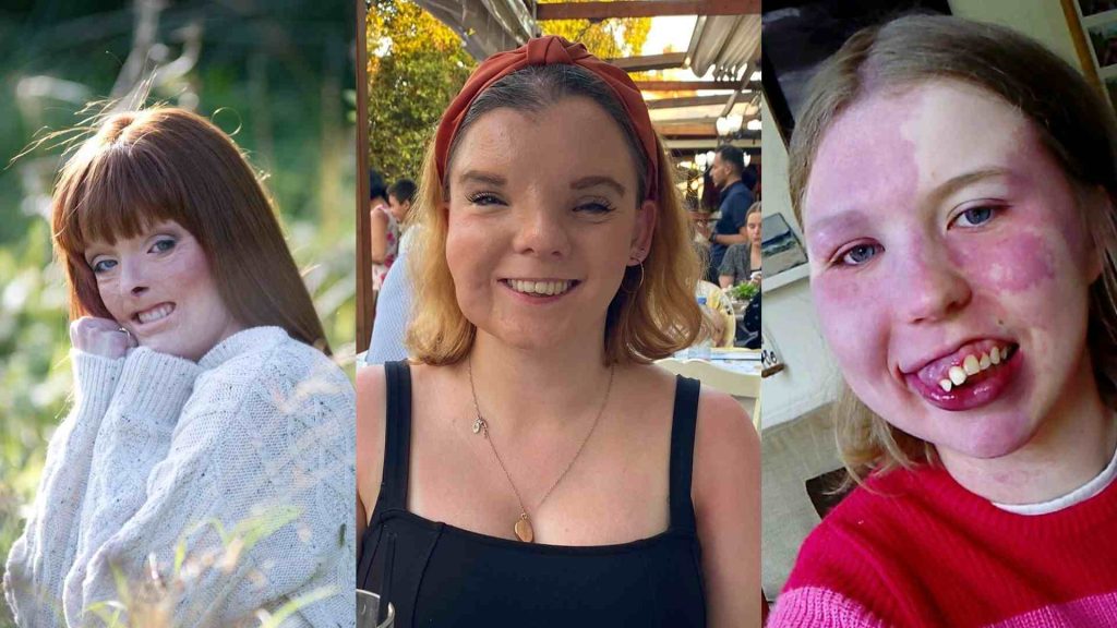 Three pictures of campaigners arranged side by side. Left is a woman with burns in a field, middle is a woman with a facial difference in a restaurant, right is a smiling woman with a facial birthmark.