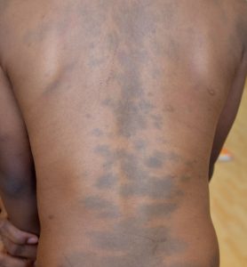 A black-skinned person's back showing blue grey spots (also known as Mongolian blue spot)