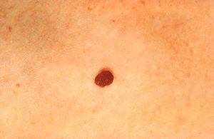 White skin with a normal mole