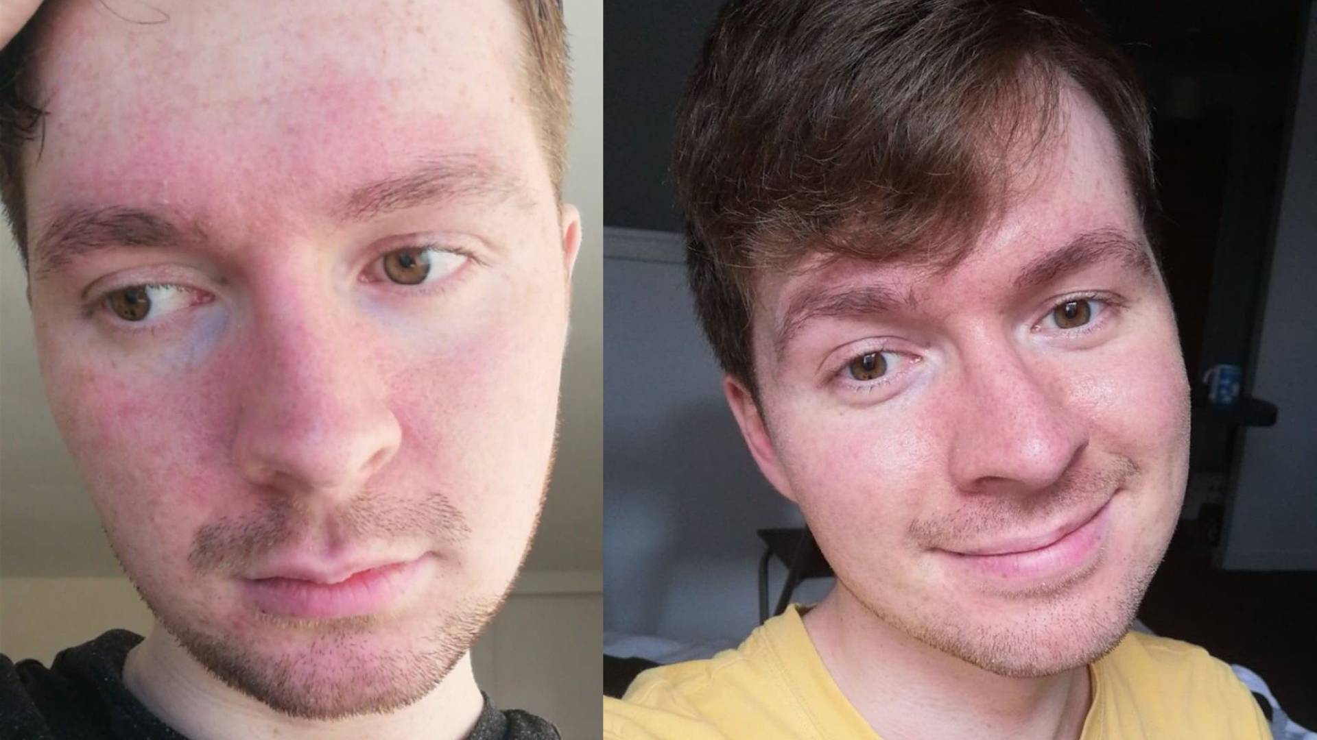Sam once struggled with the appearance of his seborrheic dermatitis but has learned acceptance