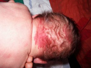 The back of a white-skinned baby's head showing nevus flammeus (also known as a stork bite birthmark)