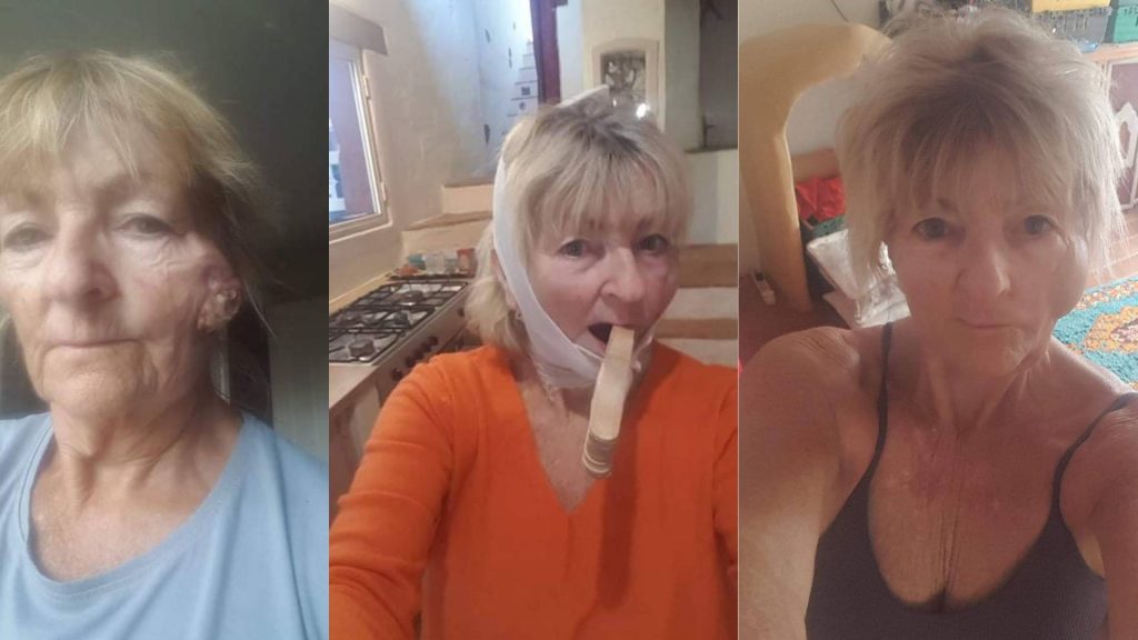 Sue at three different stages in her treatment