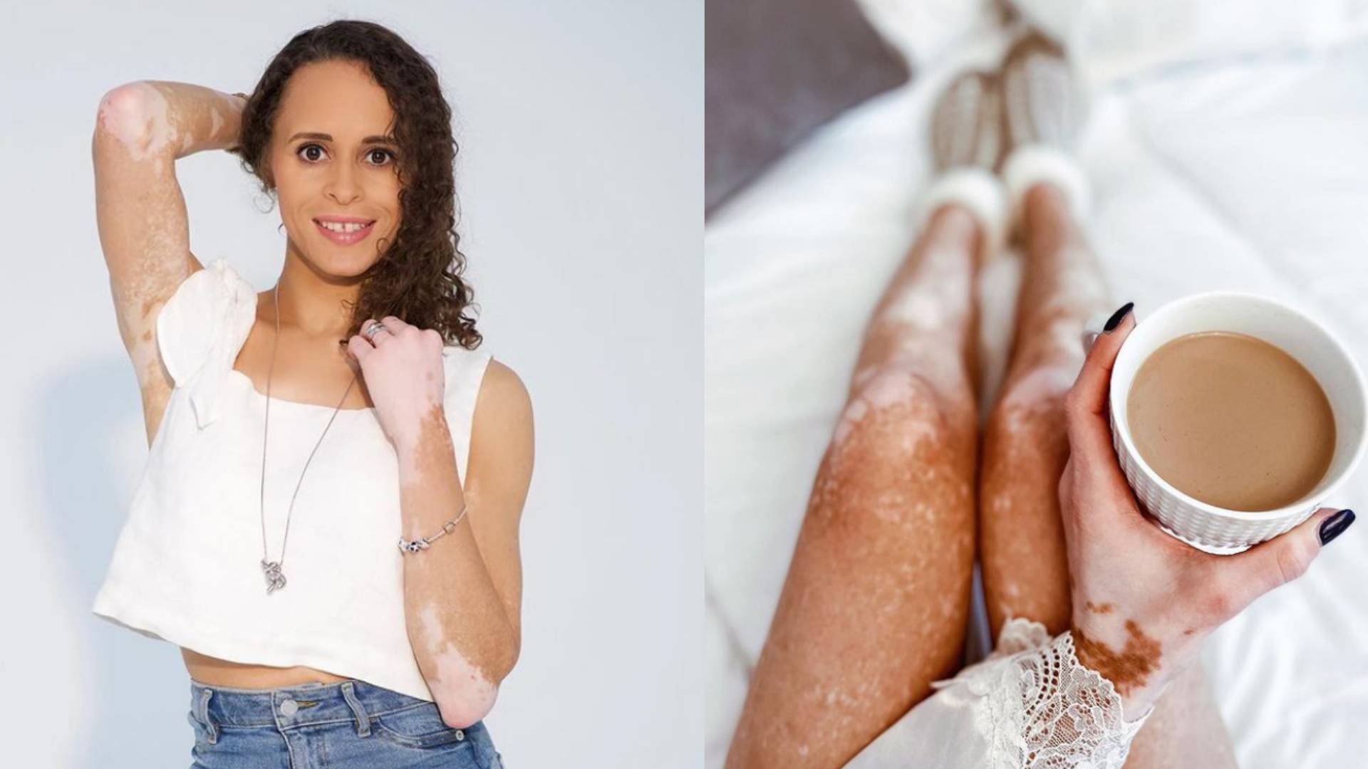 Natalie has vitiligo covering much of her body
