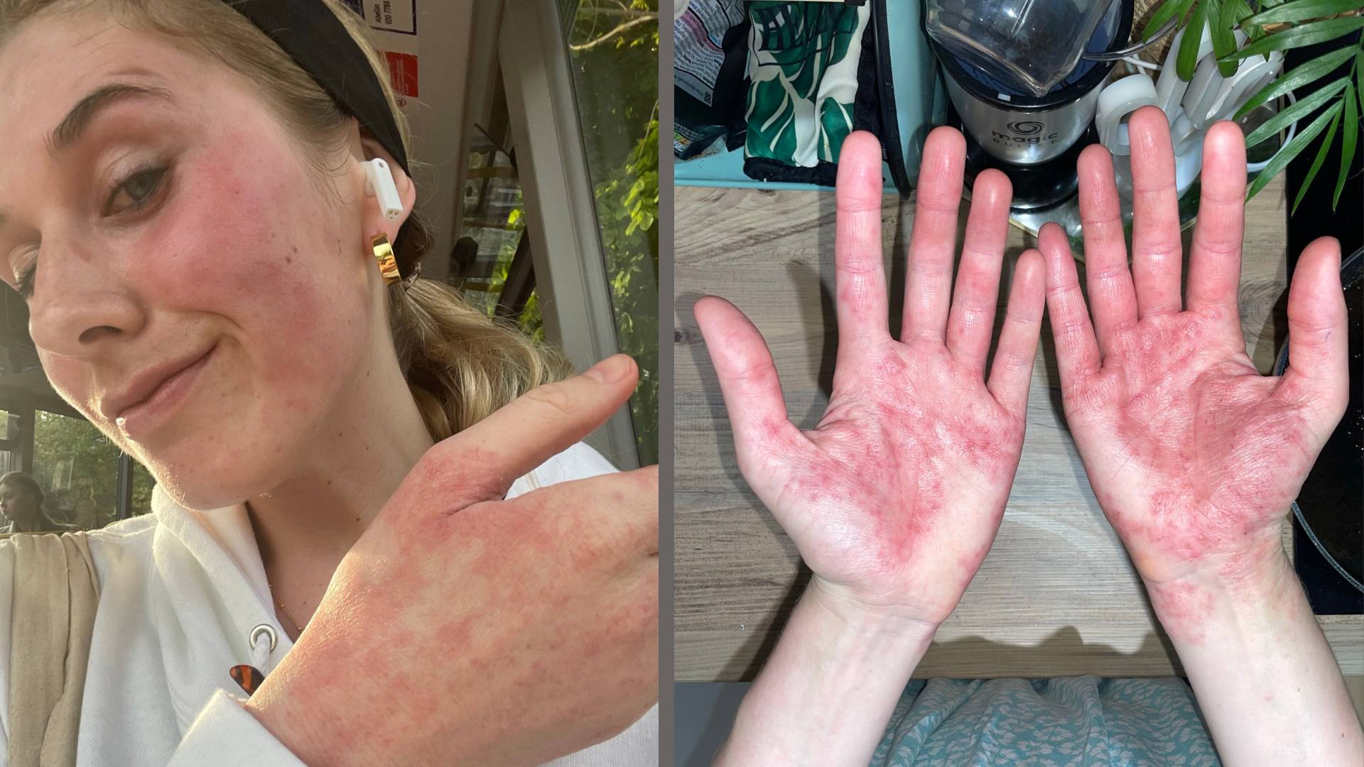 Two photos of Katie that show an eczema flare-up. On is just the palm of her hands, outstretched. The other is a close-up of her face and the other one her hands