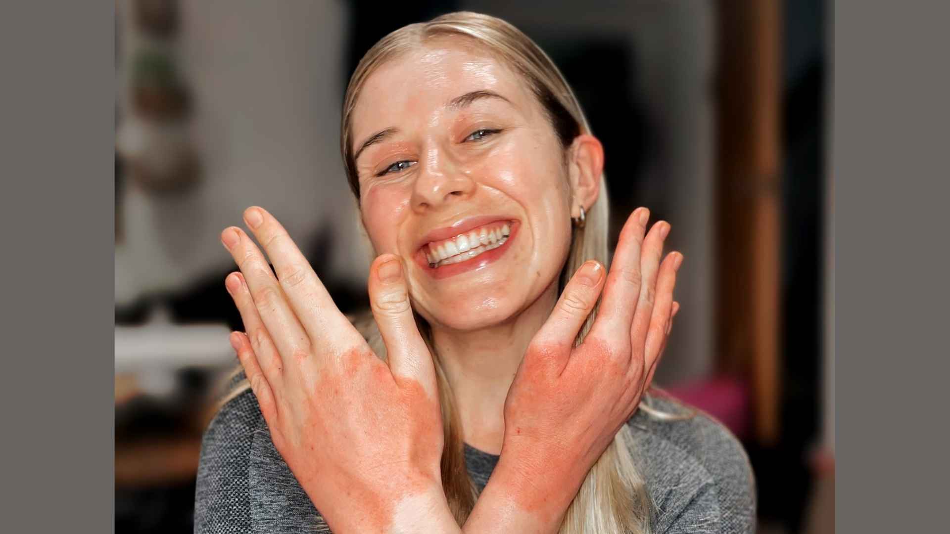 Katie is blonde and in her early twenties. She's smiling at the camera holding up the backs of her hands near her face to show an eczema flare-up