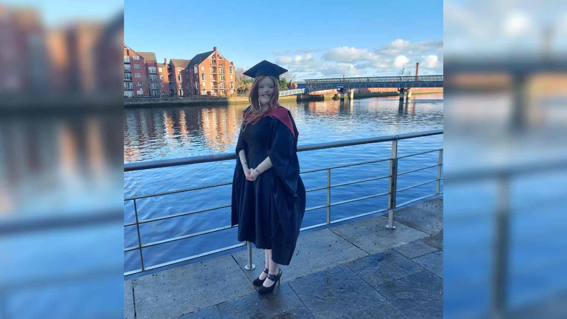 A woman with burns scars stands in front of a river with a graduation outfit on